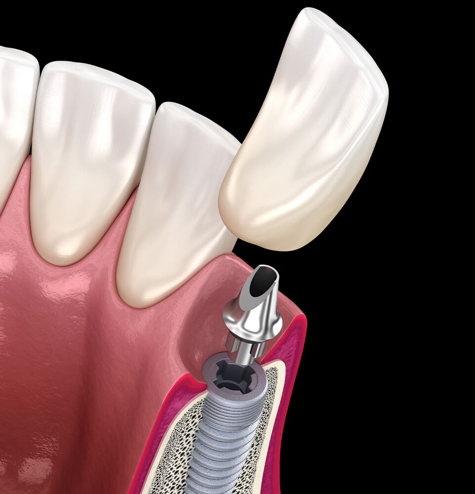dental implant 3d