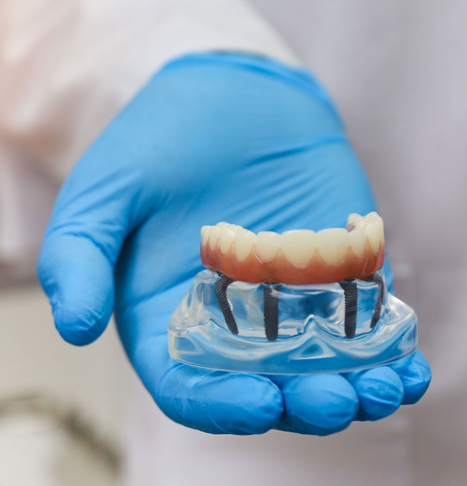 full mouth implants